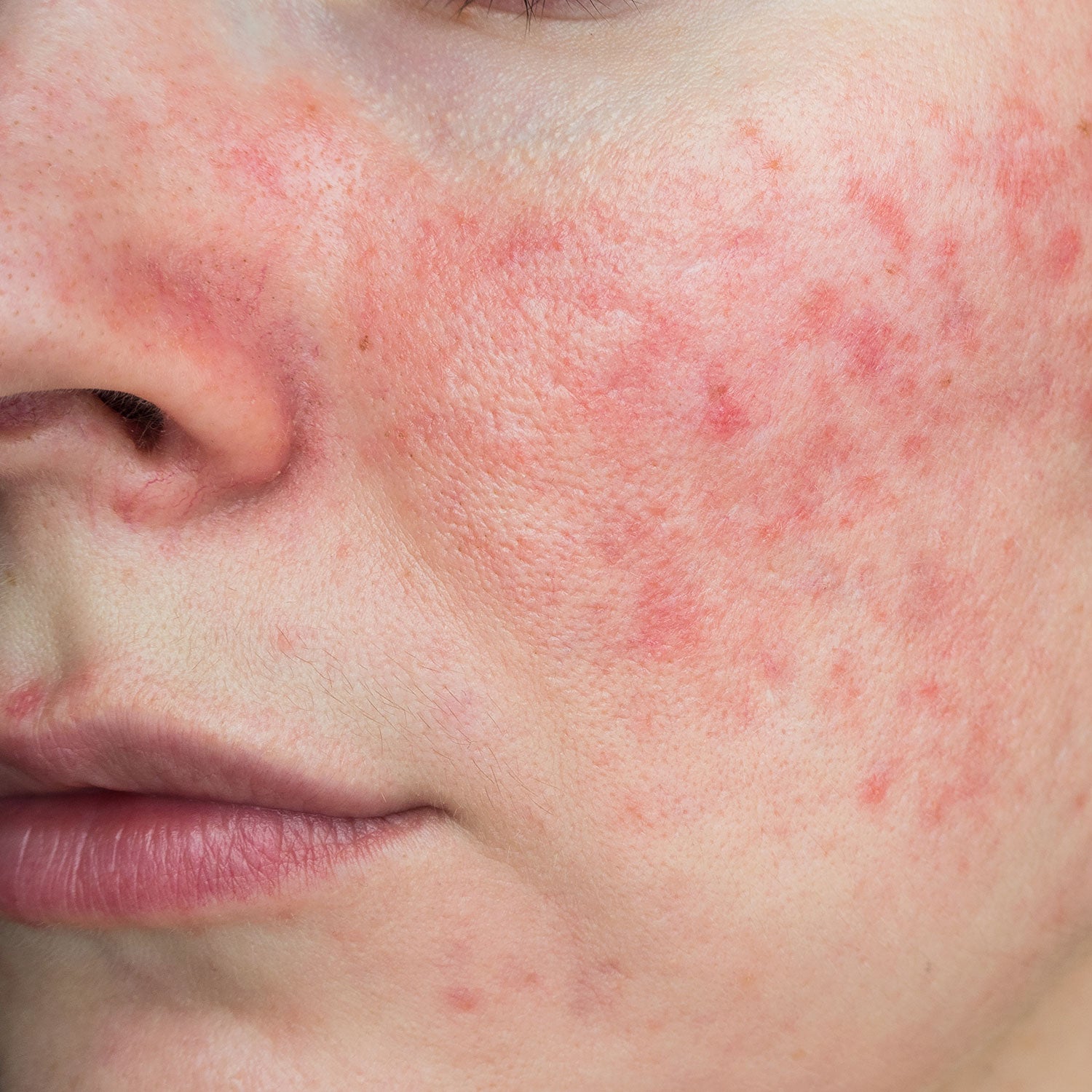 Products for rosacea